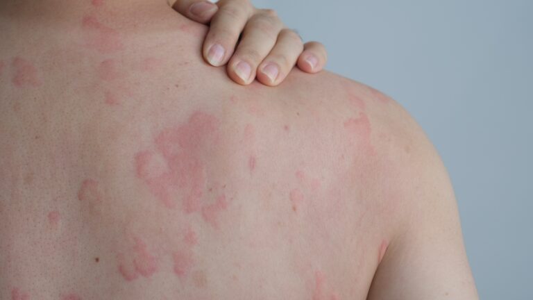 Navigating Seasonal Allergies: Understanding and Managing Skin Reactions &  Rashes